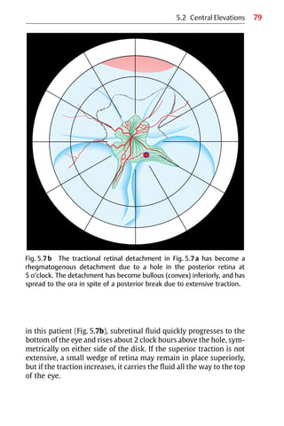 79
Fig. 5.7b The tractional retinal detachment in Fig. 5.7a has become a
rhegmatogenous detachment due to a hole in the posterior retina at
5 o’clock. The detachment has become bullous (convex) inferiorly, and has
spread to the ora in spite of a posterior break due to extensive traction.
in this patient (Fig. 5.7b), subretinal fluid quickly progresses to the
bottom of the eye and rises about 2 clock hours above the hole, sym-
metrically on either side of the disk. If the superior traction is not
extensive, a small wedge of retina may remain in place superiorly,
but if the traction increases, it carries the fluid all the way to the top
of the eye.
5.2 Central Elevations
 