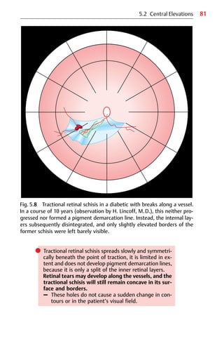 81
Fig. 5.8 Tractional retinal schisis in a diabetic with breaks along a vessel.
In a course of 10 years (observation by H. Lincoff, M.D.), this neither pro-
gressed nor formed a pigment demarcation line. Instead, the internal lay-
ers subsequently disintegrated, and only slightly elevated borders of the
former schisis were left barely visible.
5.2 Central Elevations
쎲 Tractional retinal schisis spreads slowly and symmetri-
cally beneath the point of traction, it is limited in ex-
tent and does not develop pigment demarcation lines,
because it is only a split of the inner retinal layers.
Retinal tears may develop along the vessels, and the
tractional schisis will still remain concave in its sur-
face and borders.
– These holes do not cause a sudden change in con-
tours or in the patient’s visual field.
 