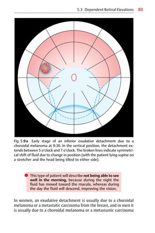 83
Fig. 5.9a Early stage of an inferior exudative detachment due to a
choroidal melanoma at 9:30. In the vertical position, the detachment ex-
tends between 5 o’clock and 7 o’clock. The broken lines indicate symmetri-
cal shift of fluid due to change in position (with the patient lying supine on
a stretcher and the head being tilted to either side).
5.3 Dependent Retinal Elevations
쎲 This type of patient will describe not being able to see
well in the morning, because during the night the
fluid has moved toward the macula, whereas during
the day the fluid will descend, improving the vision.
In women, an exudative detachment is usually due to a choroidal
melanoma or a metastatic carcinoma from the breast, and in men it
is usually due to a choroidal melanoma or a metastastic carcinoma
 