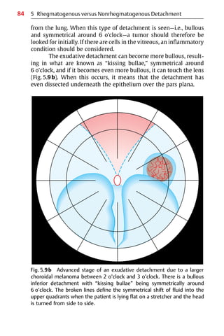 84
from the lung. When this type of detachment is seen—i.e., bullous
and symmetrical around 6 o’clock—a tumor should therefore be
looked for initially. If there are cells in the vitreous, an inflammatory
condition should be considered.
The exudative detachment can become more bullous, result-
ing in what are known as “kissing bullae,” symmetrical around
6 o’clock, and if it becomes even more bullous, it can touch the lens
(Fig. 5.9b). When this occurs, it means that the detachment has
even dissected underneath the epithelium over the pars plana.
5 Rhegmatogenous versus Nonrhegmatogenous Detachment
Fig. 5.9b Advanced stage of an exudative detachment due to a larger
choroidal melanoma between 2 o’clock and 3 o’clock. There is a bullous
inferior detachment with “kissing bullae” being symmetrically around
6 o’clock. The broken lines define the symmetrical shift of fluid into the
upper quadrants when the patient is lying flat on a stretcher and the head
is turned from side to side.
 