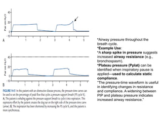 •Airway pressure throughout the
breath cycle.
•Example Use:
•A sharp spike in pressure suggests
increased airway resistance (e.g.,
bronchospasm).
•Plateau pressure (Pplat) can be
identified when inspiratory pause is
applied—used to calculate static
compliance.
“The pressure-time waveform is useful
in identifying changes in resistance
and compliance. A widening between
PIP and plateau pressure indicates
increased airway resistance.”
 
