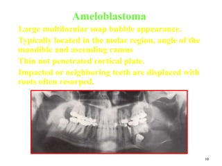10
Ameloblastoma
Large multilocular soap bubble appearance.
Typically located in the molar region, angle of the
mandible and ascending ramus
Thin not penetrated cortical plate.
Impacted or neighboring teeth are displaced with
roots often resorped.
 