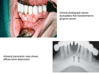 106
Clinical photograph shows
leukoplakia that transformed to
gingival cancer
Intraoral panoramic view shows
diffuse bone destruction
 