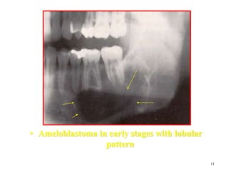 11
• Ameloblastoma in early stages with lobular
pattern
 