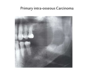 Primary intra-osseous Carcinoma
 