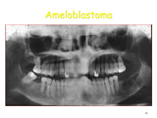 12
Ameloblastoma
 