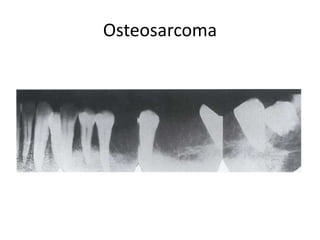 Osteosarcoma
 
