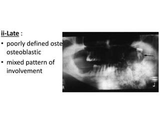 125
ii-Late :
• poorly defined osteolytic,
osteoblastic
• mixed pattern of
involvement
 
