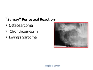 Naglaa S. El Kilani
127
“Sunray” Periosteal Reaction
• Osteosarcoma
• Chondrosarcoma
• Ewing’s Sarcoma
 