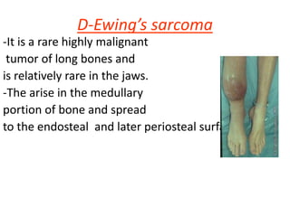 D-Ewing’s sarcoma
-It is a rare highly malignant
tumor of long bones and
is relatively rare in the jaws.
-The arise in the medullary
portion of bone and spread
to the endosteal and later periosteal surfaces.
 