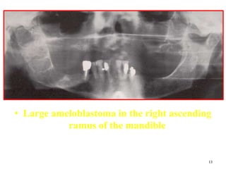 13
• Large ameloblastoma in the right ascending
ramus of the mandible
 
