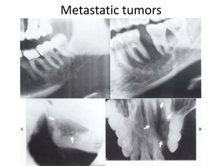 Metastatic tumors
 
