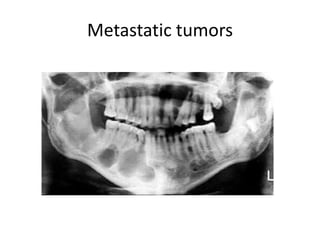 Metastatic tumors
 