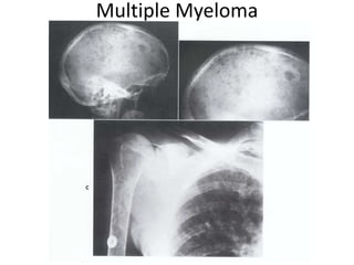 Multiple Myeloma
 
