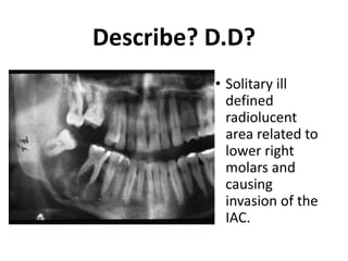 Describe? D.D?
• Solitary ill
defined
radiolucent
area related to
lower right
molars and
causing
invasion of the
IAC.
 