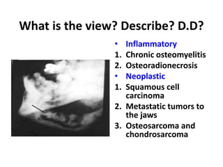 What is the view? Describe? D.D?
• Inflammatory
1. Chronic osteomyelitis
2. Osteoradionecrosis
• Neoplastic
1. Squamous cell
carcinoma
2. Metastatic tumors to
the jaws
3. Osteosarcoma and
chondrosarcoma
 