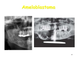 14
Ameloblastoma
 