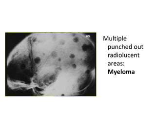 Multiple
punched out
radiolucent
areas:
Myeloma
 