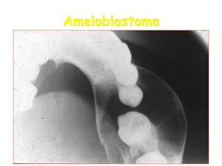 15
Ameloblastoma
 