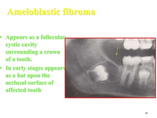 16
Ameloblastic fibroma
• Appears as a follecular
cystic cavity
surrounding a crown
of a tooth.
• In early stages appears
as a hat upon the
occlusal surface of
affected tooth
 