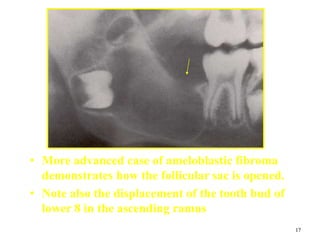 17
• More advanced case of ameloblastic fibroma
demonstrates how the follicular sac is opened.
• Note also the displacement of the tooth bud of
lower 8 in the ascending ramus
 