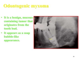 18
Odontogenic myxoma
• It is a benign, mucous-
containing tumor that
originates from the
tooth bud.
• It appears as a soap
bubble-like
appearance.
 