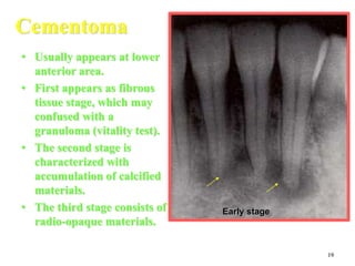 19
Cementoma
• Usually appears at lower
anterior area.
• First appears as fibrous
tissue stage, which may
confused with a
granuloma (vitality test).
• The second stage is
characterized with
accumulation of calcified
materials.
• The third stage consists of
radio-opaque materials.
Early stage
 