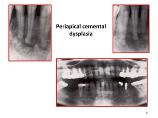21
Periapical cemental
dysplasia
 