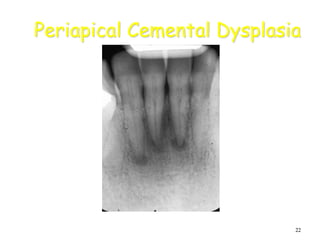 22
Periapical Cemental Dysplasia
 