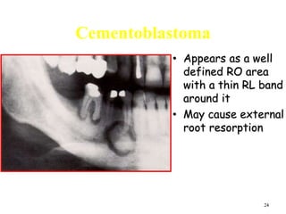 24
Cementoblastoma
• Appears as a well
defined RO area
with a thin RL band
around it
• May cause external
root resorption
 