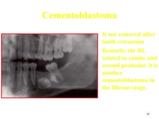 25
Cementoblastoma
• It not removed after
tooth extraction
• Remarks the RL
related to canine and
second premolar, it is
another
cementoblastoma in
the fibrous stage.
 