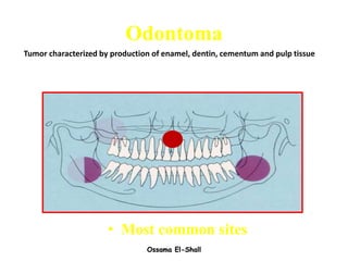 Ossama El-Shall
Odontoma
• Most common sites
Tumor characterized by production of enamel, dentin, cementum and pulp tissue
 