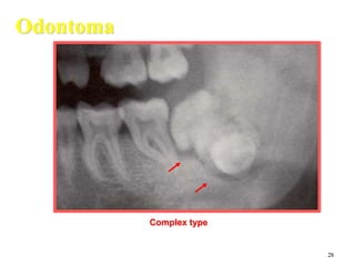 28
Odontoma
Complex type
 