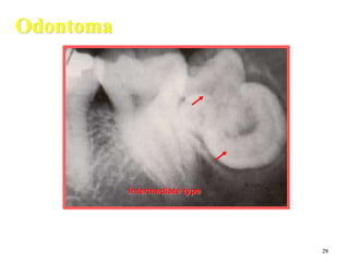 29
Odontoma
Intermediate type
 