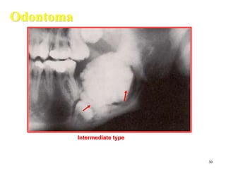 30
Odontoma
Intermediate type
 