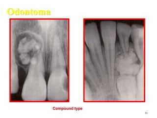 31
Odontoma
Compound type
 
