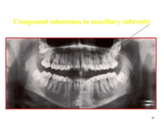 32
Compound odontoma in maxillary tubrosity
 