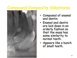 34
Compound Composite Odontoma
• Composed of enamel
and dentin.
• Enamel and dentin
are laid down in an
orderly fashion so
that the mass has
some similarity to
normal teeth.
• Appears like a bunch
of small teeth.
 
