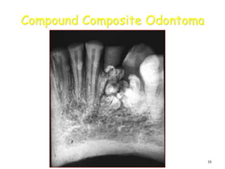 35
Compound Composite Odontoma
 