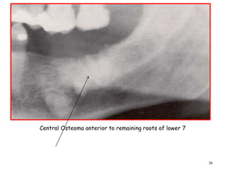 36
Central Osteoma anterior to remaining roots of lower 7
 