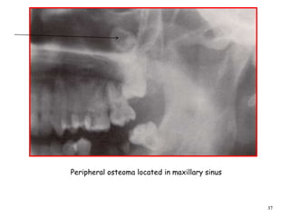 37
Peripheral osteoma located in maxillary sinus
 
