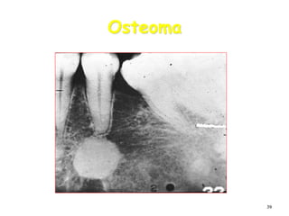 39
Osteoma
 