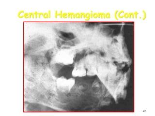 42
Central Hemangioma (Cont.)
 