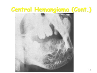 43
Central Hemangioma (Cont.)
 