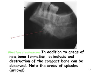 47
Mixed form of ostiosarcoma: In addition to areas of
new bone formation, osteolysis and
destruction of the compact bone can be
observed. Note the areas of spicules
(arrows)
 