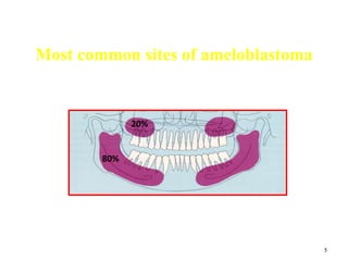 5
Most common sites of ameloblastoma
80%
20%
 