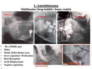 1- Ameloblastoma
Multilocular (Soap bubble> honey comb))
origin (dental lamina and dental organ)
• 40 y (Middle age)
• Males
• Mand. Molar Ramus area
• Sever expansion +Perforation
• Root Resorption
• Teeth Displacement
• Negative aspiration
Unicystic (Rare)Inter radicular
(Uncommon)
Solitary
Periapical Pericoronal
 