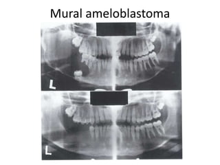 Mural ameloblastoma
 