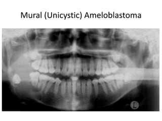 Mural (Unicystic) Ameloblastoma
 