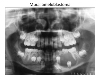 Mural ameloblastoma
 